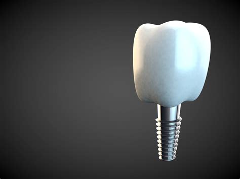 How Long Dental Implant Procedures Take | Dentist Near You