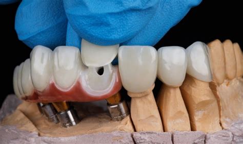 Exploring Your Choices Three Types Of Dental Crowns