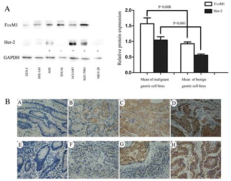 Overexpression Of Her 2 Upregulates FoxM1 In Gastric Cancer