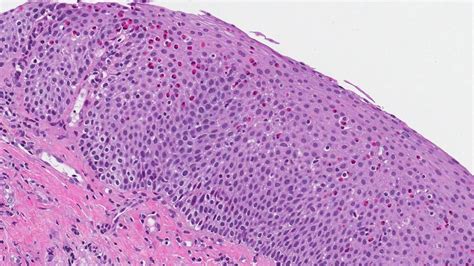 esophagitis Archives | Atlas of Pathology