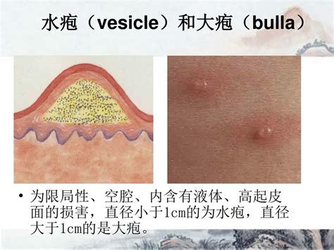 Ppt 第四章 皮肤性病的临床表现 和诊断 山西医科大学第二医院 皮肤性病科 Powerpoint Presentation Id