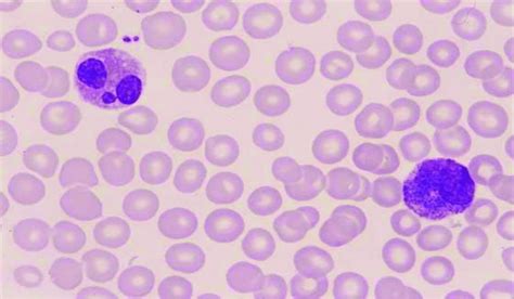 Basophil with large and dark colored granules in the cytoplasm of ...