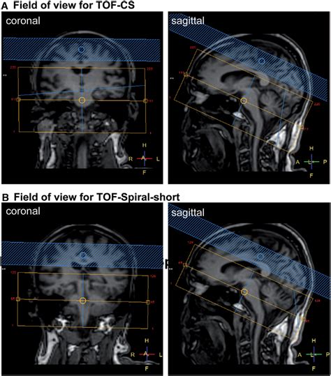 Female patient with vertigo and ataxia undergoing MRI including ...