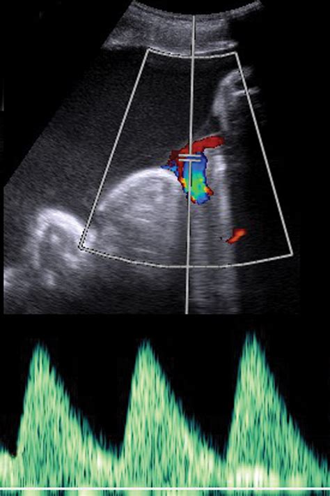 A Radiologists Guide To The Performance And Interpretation Of Obstetric Doppler Us Radiographics