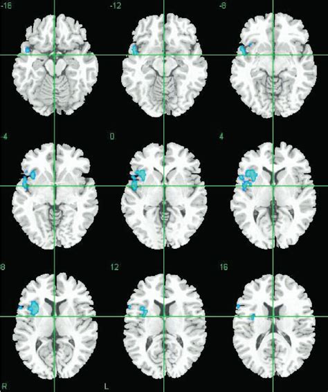 Areas Of Reduced Gray Matter Volume In At Risk Mental State Arms