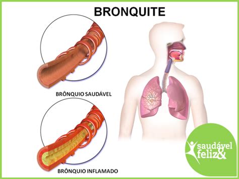 Bronquite Sintomas Tratamento E A Preven O No Blog Mais Saud Vel