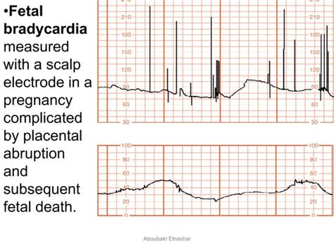 Cardiotocography Ctg Antepartum And Intrapartum