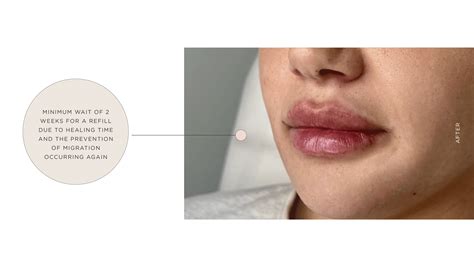 Lip Filler Dissolving