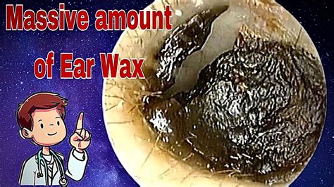 Massive Amount of Ear Wax Removal UNedited 귀지 안전하게 제거 딱딱한 귀지 막힘 귀지