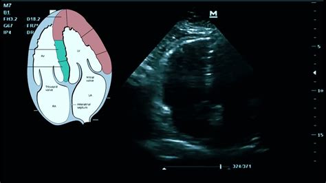 Signos Ecocardiogr Ficos De Tromboembolia Pulmonar Short Youtube