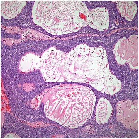 Frontiers Thymic Carcinoma A Review