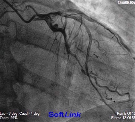 Surprising Ecg Pattern Suggestive Of An Anterior Wall Ischaemia In A