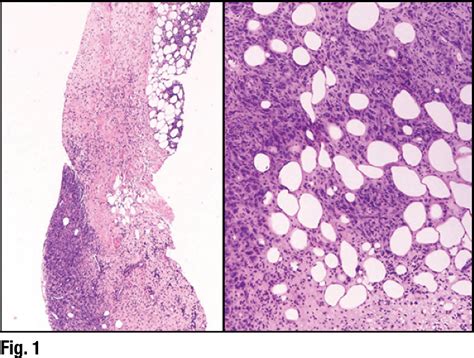 Core needle biopsy of the breast: cases and cautions - CAP TODAY