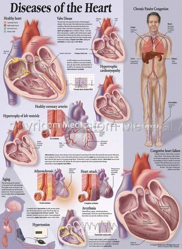 Understanding Colorectal Cancer Chart 20×26 Artofit