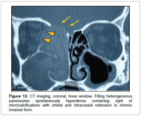 Double Density Sign In Fungal Sinusitis Mri Shows T2 Hypointensity