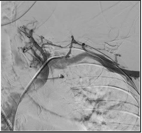 Female Patient With Massive Refractory Chylous Ascites Following Paraaortic Lymph Node Biopsy.