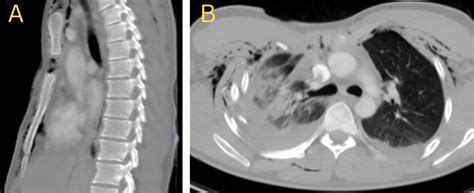 Stabilization Of The Anterior Flail Chest And Lung Resection In A