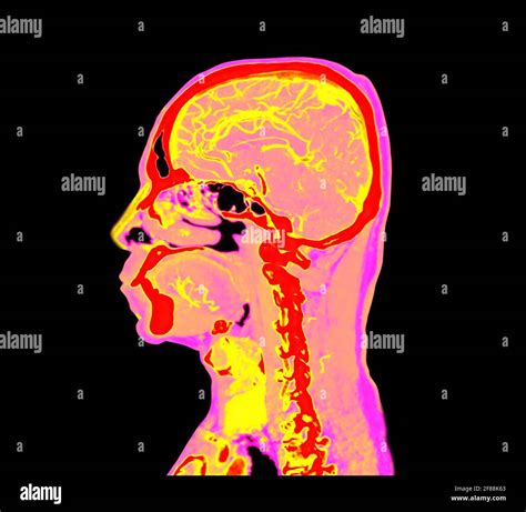 Colorful Of Ct Angiography Of The Brain Or Cta Brain Sagittal View