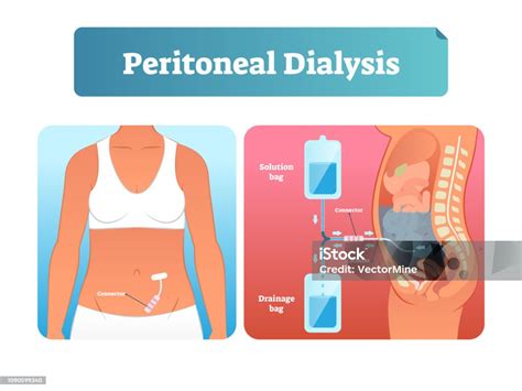 Peritoneal Dialysis Vector Illustration Labeled Method To Exchange