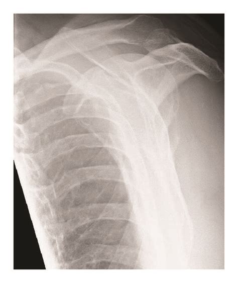 Anterior Posterior A And Lateral B Radiographs Of Our Patients