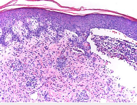 Hematoxylin And Eosin Hande Stain 10x Original Biopsy Highlighting The