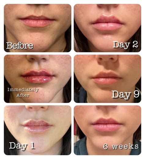 How Long Does 0 5 ML Lip Filler Last