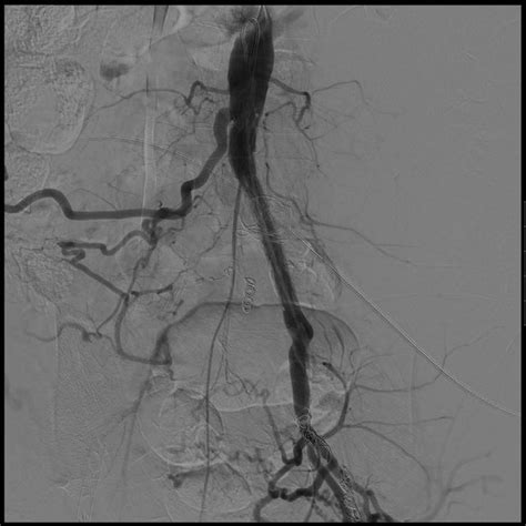 Digital Subtraction Angiography Demonstrating The Final Result After