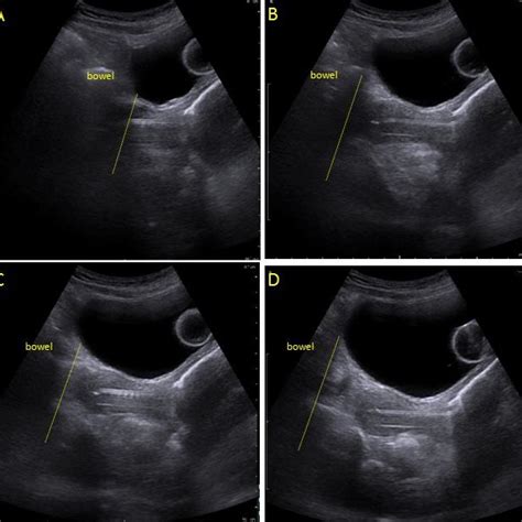 Fig A1. Overview of brachytherapy procedure. Source: Peter MacCallum ...