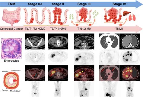 Frontiers Tailoring The Clinical Management Of Colorectal Cancer By