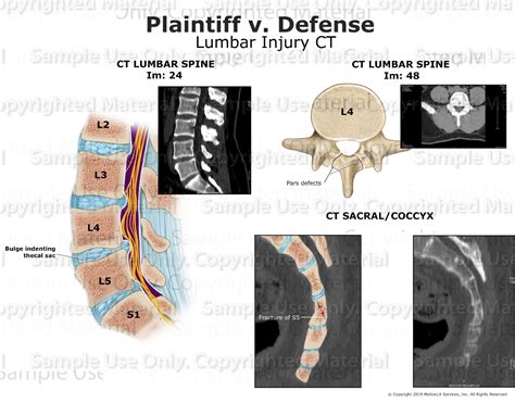 pars fracture sacral fracture motionlit