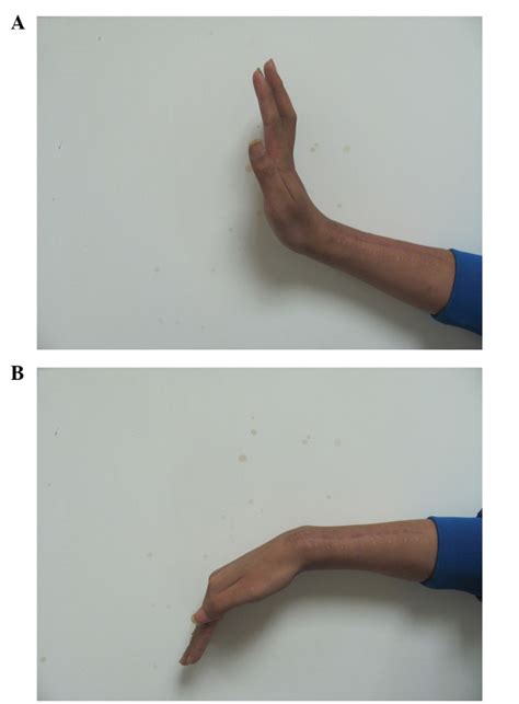 Physical examination of the affected wrist showed (A) active ...