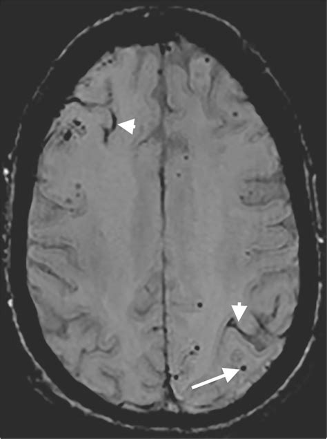 Cerebral Amyloid Angiopathy MRI