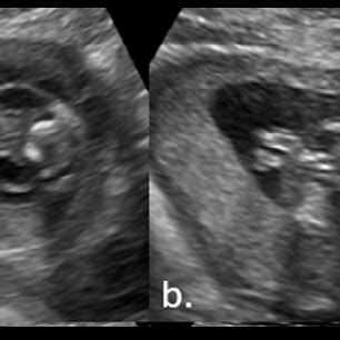 Ultrasound At 20 Weeks Of Pregnancy Showing Septal Cervical Cystic