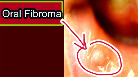 Oral Fibroma Symptoms Causes Treatment Youtube