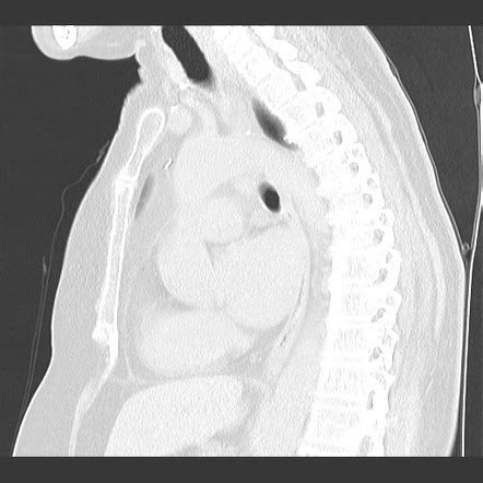 Pulmonary Langerhans Cell Histiocytosis Image Radiopaedia Org