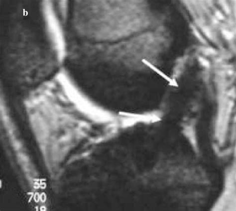 A B Follow Up At 30 Months Sagittal T1 Weighted Spin Echo SE A And