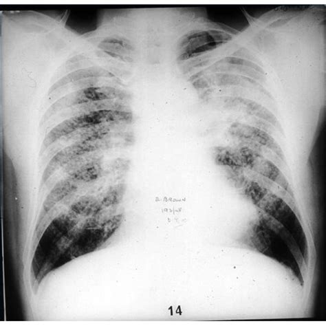 Pulmonary Fibrosis Stages