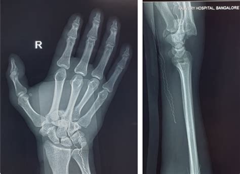 Carpometacarpal Joint Dislocation