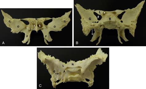 The Sphenoid Bone Radiology Key