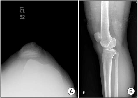 A Subluxation Of The Patella And Aplasia Of The Trochlear Groove On