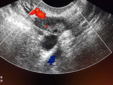 Parapelvic Cyst Ultrasound