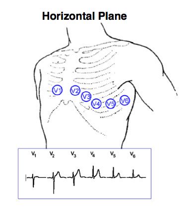 Ekg Exam Flashcards Quizlet