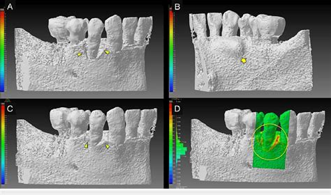 3d Views Of Pre And Post Operative Cone Beam Computed Tomography Cbct Download Scientific