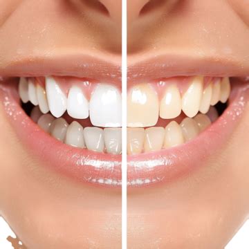 Healthy Teeth Whitening Whitening Tooth Dental Png Transparent Image