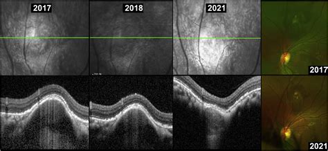 Clinical Features And Multimodal Imaging Findings Of Focal Scleral Nodule Potential Association