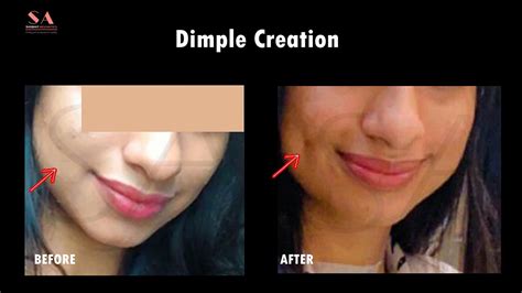 Dimple Surgery Before And After