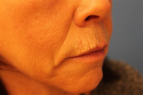 Fractional Laser Skin Resurfacing Case 2 Cascade Facial Surgery And