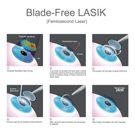 Lasik Las Vegas Bladeless Lasik Las Vegas Shepherd Eye