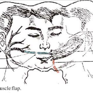 Schematic representation of one-stage free gracilis flap to face. | Download Scientific Diagram