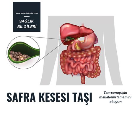 SAFRA KESESİ TAŞI NASIL DÜŞÜRÜLÜR Ev Yapımı Tatlar